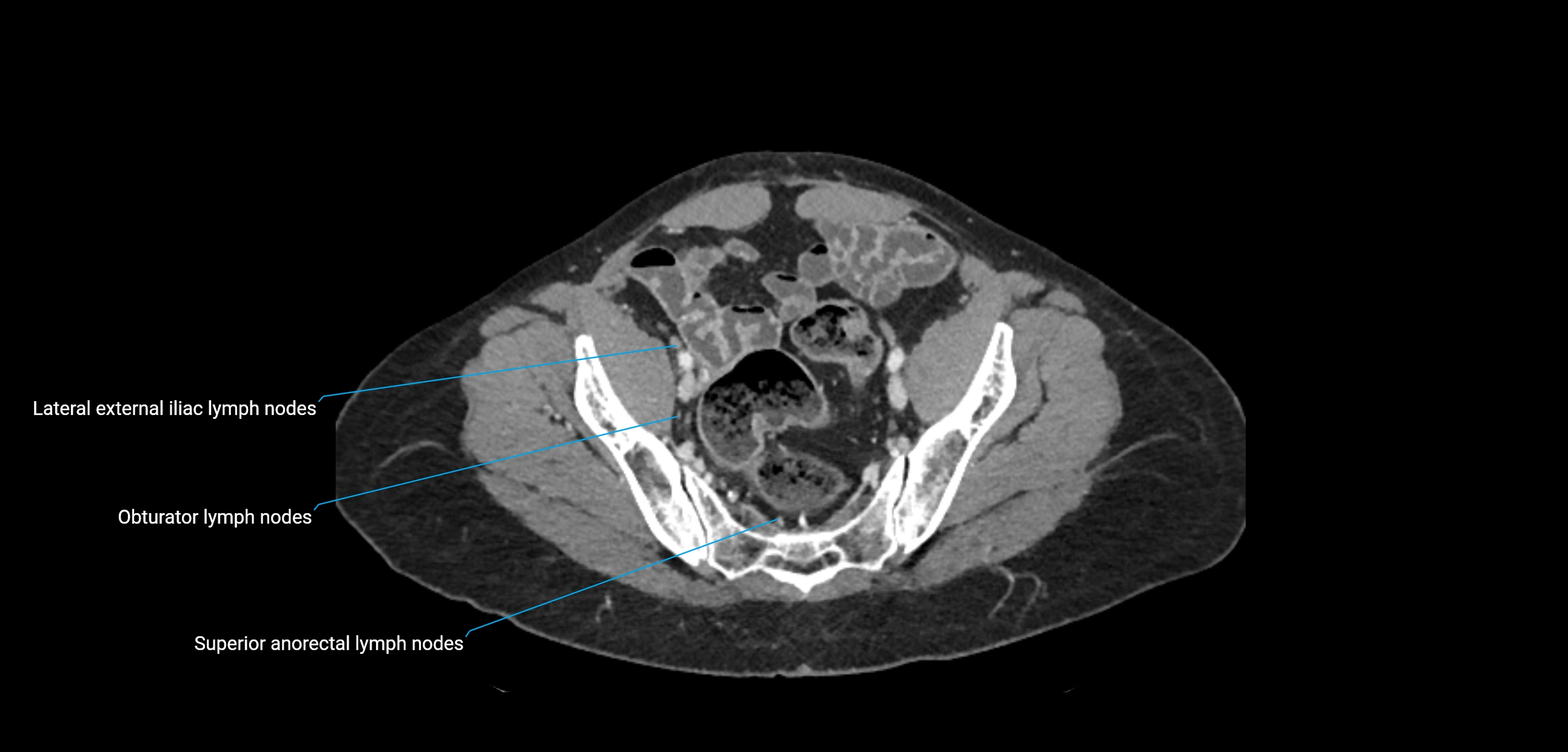 CT ct abdominal lymph nodes  axial cross sectional anatomy  enchanced radiology image -img-00002-00345.webp